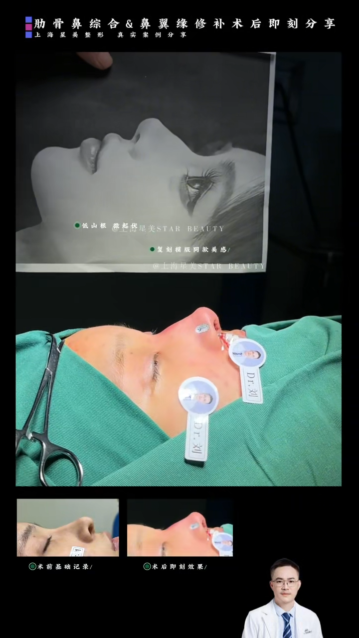 Kasus Segera Pasca Operasi Sintesis Nasal Ribs + Perbaikan Flanges Nasal: Program Gabungan "Pendukung Tip Nasal + Reduksi Flanges Nasal"