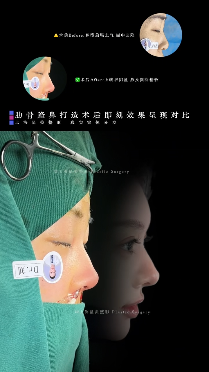 Perbandingan Efek Segera Pasca Operasi Pembentukan Hidung Rangi (Rib-Rangi Neoprosthesis)
