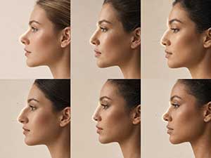 Rencana koreksi enam jenis deformitas hidung (nasal malformations) Rencana koreksi enam jenis deformitas hidung
