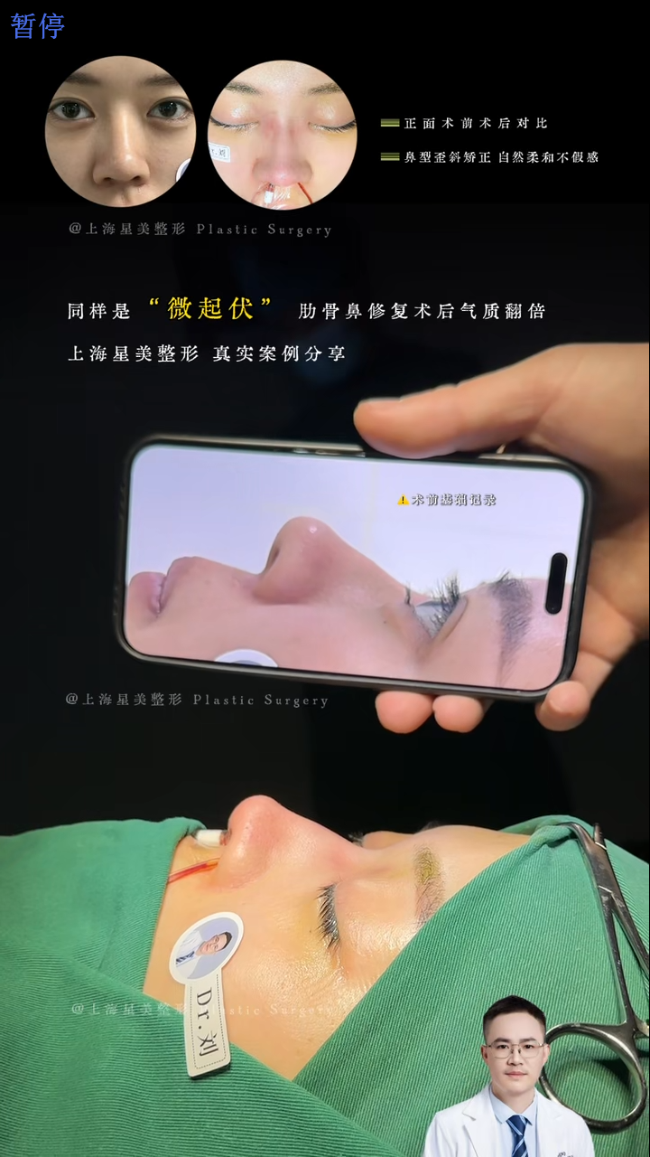 Perbaikan Hidung Rib Micro-Rubbed (Rubbed Rib Micro-Rubbed)