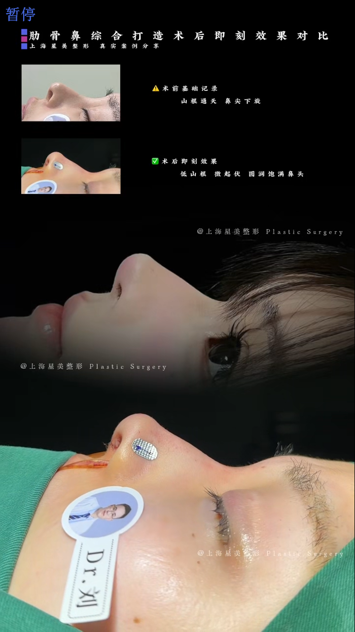 Komparasi segera pasca operasi dengan sindrom rib-nasal (rib-nasal syndrome)